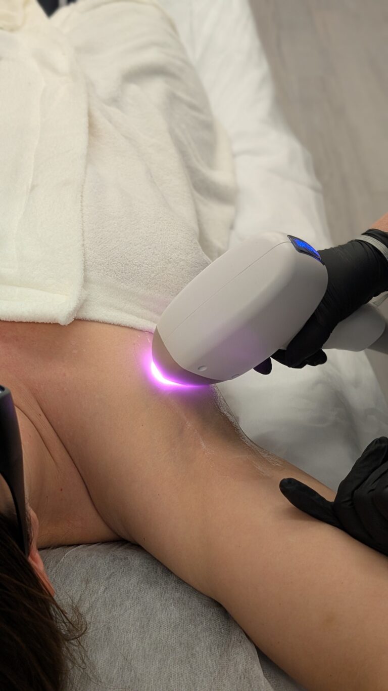 laserhairremoval