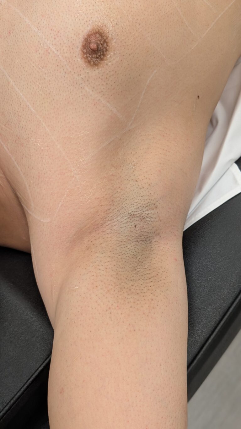 laserhairremoval