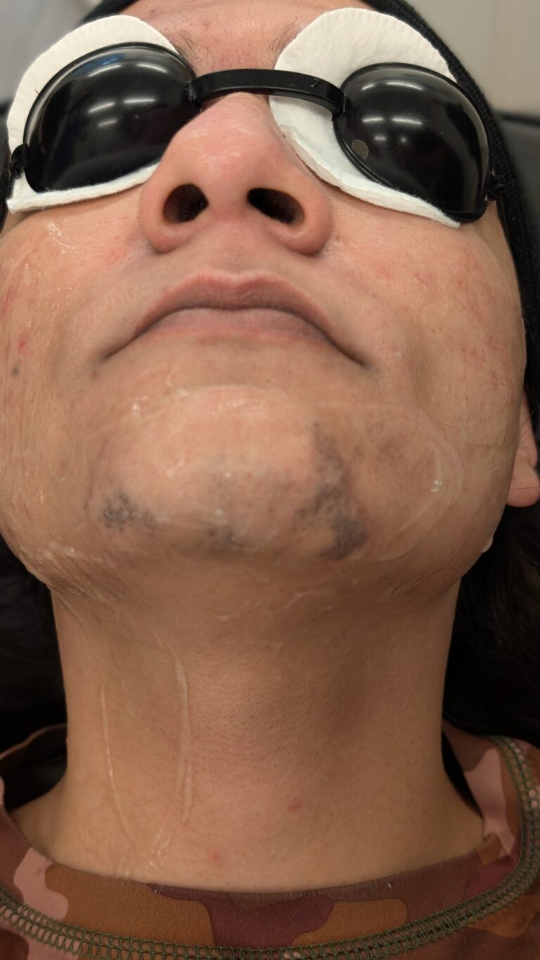laserhairremoval