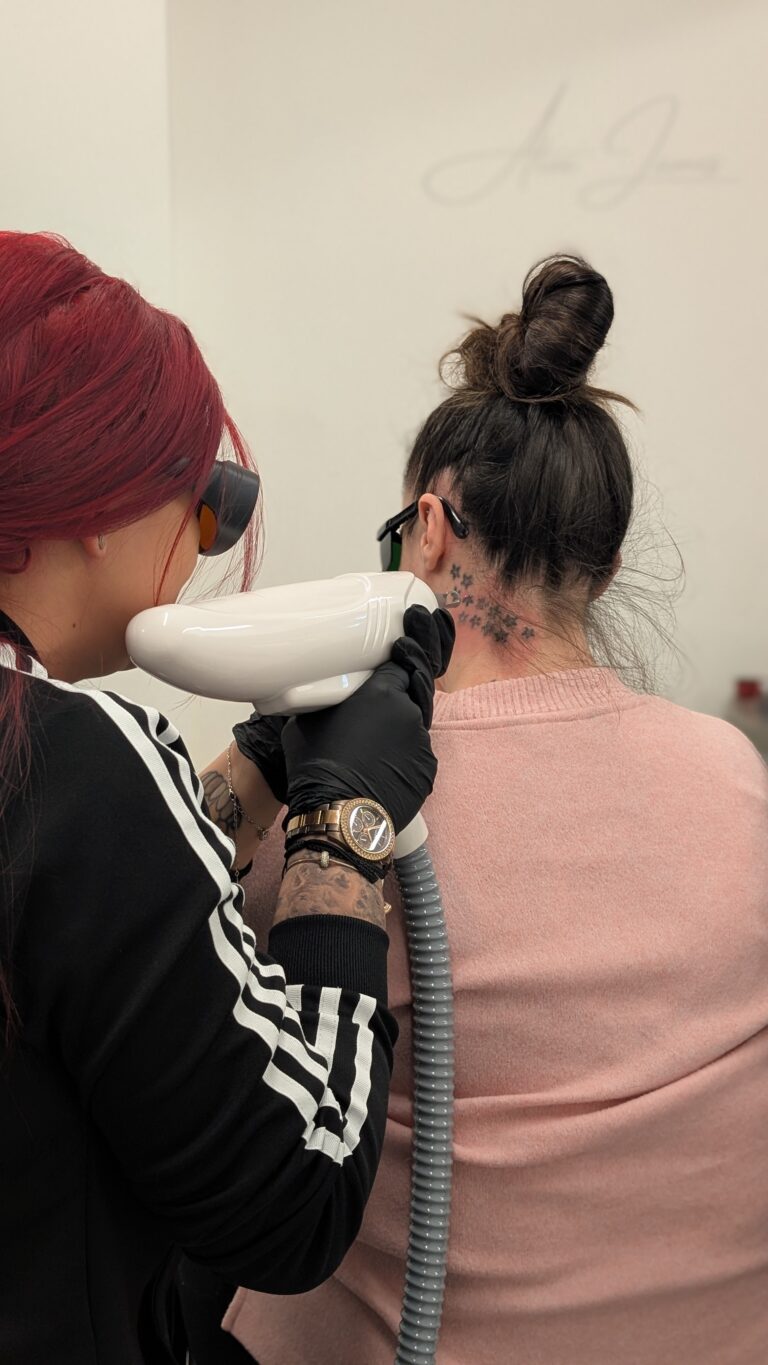 lasertattooremoval