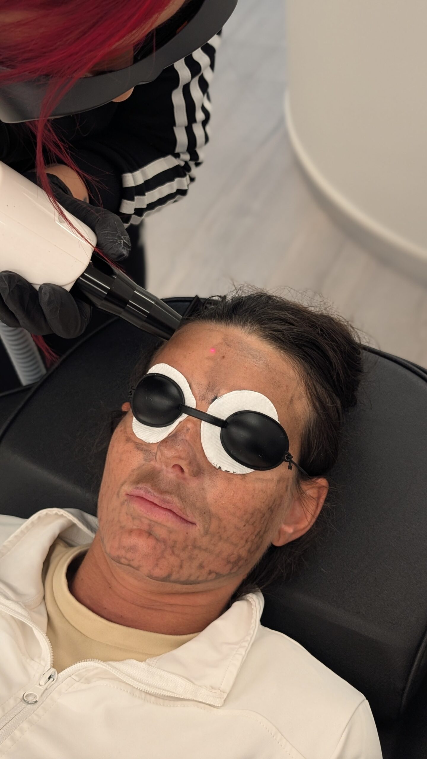 carbonlaserfacial