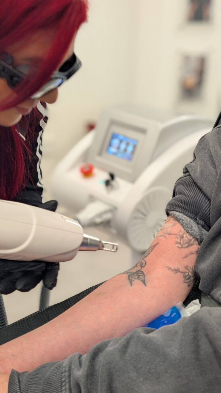 lasertattooremoval