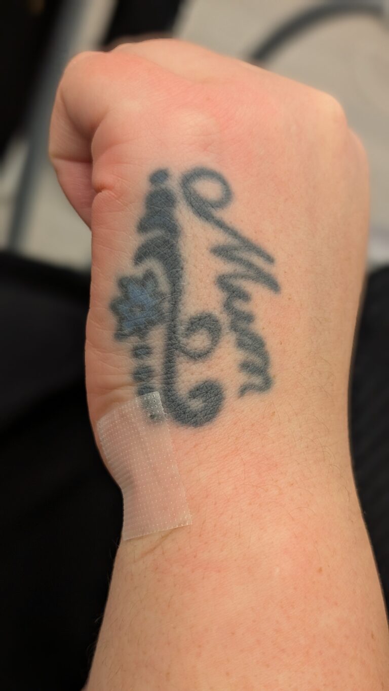 lasertattooremoval